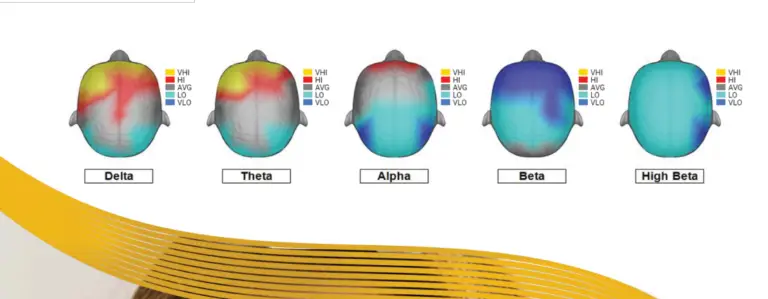 Illustration of a quantitative EEG brain map showing delta, theta, alpha, beta, and high beta brainwave activity used to support individualized Functional Neurofeedback assessment.
